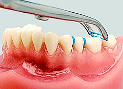 کش سپریتور ارتودنسی | دکتر فرهاد صدرالدینی