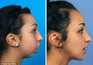 تاثیر ارتودنسی بر بینی | دکتر فرهاد صدرالدینی