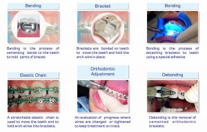 مراحل ارتودنسی | دکتر فرهاد صدرالدینی