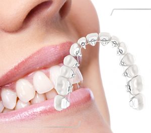 هزینه ارتودنسی فک پایین | دکتر فرهاد صدرالدینی
