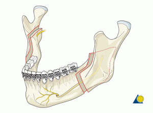 برش استخوان فک پایین | دکتر فرهاد صدرالدینی