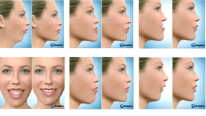 ارتودنسی همراه با جراحی فک | دکتر فرهاد صدرالدینی