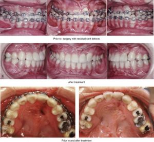 ارتودنسی ثابت شکاف لب و کام | دکتر فرهاد صدرالدینی