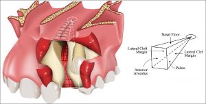 پیوند استخوان ارتودنسی شکاف لب و کام | دکتر فرهاد صدرالدینی