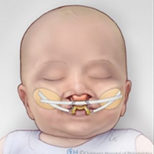 ارتوپدی نوزاد شکاف لب و کام | دکتر فرهاد صدرالدینی