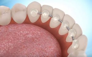 نگهدارنده ارتودنسی ثابت | دکتر فرهاد صدرالدینی