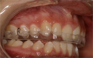 درمان ارتودنسی مشکلات مفصل فکی | دکتر فرهاد صدرالدینی