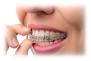 پلاک نگهدارنده ارتودنسی شفاف | دکتر فرهاد صدرالدینی