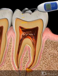 تست الکتریکی دندان ضربه خورده | دکتر فرهاد صدرالدینی