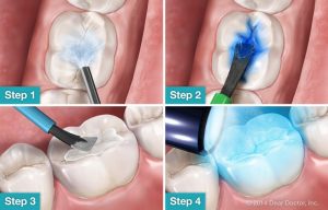 مراحل فیشور سیلانت | دکتر فرهاد صدرالدینی