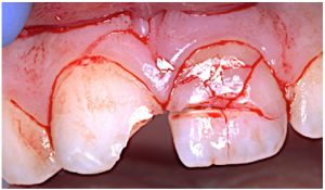 اورژانس دندان ضربه خورده | دکتر فرهاد صدرالدینی