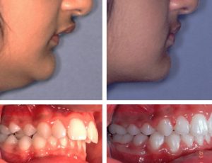 ارتودنسی فک پایین کوچک کودکان | دکتر فرهاد صدرالدینی