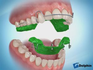 دستگاه تغییر رشد فک پایین عقب | دکتر فرهاد صدرالدینی